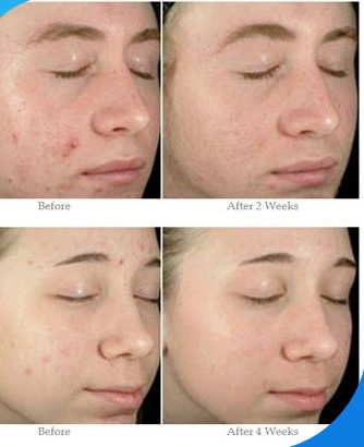 Cicatrize Acne in Montreal: Tailored Solutions for Clear, Radiant Skin | Zupyak