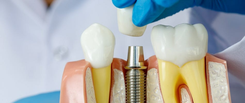 Unveiling the Truth Behind Dental Implants Cost in Hawthorn East | by Hawthorneast | Jun, 2024 | Medium
