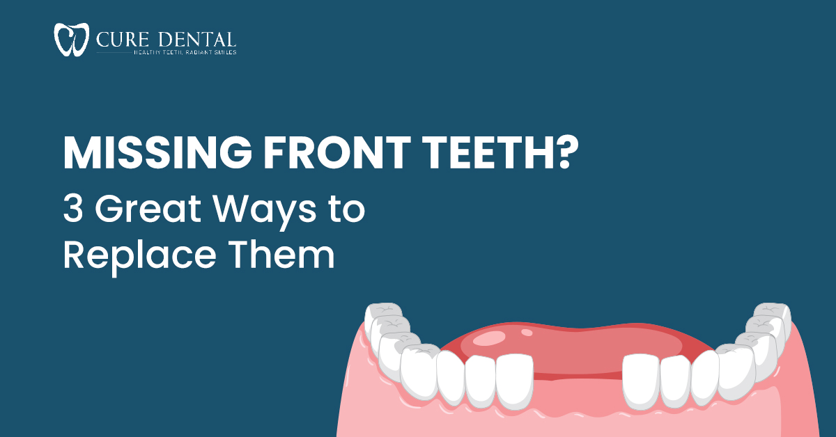 Missing Front Teeth? 3 Ways to Replace Them