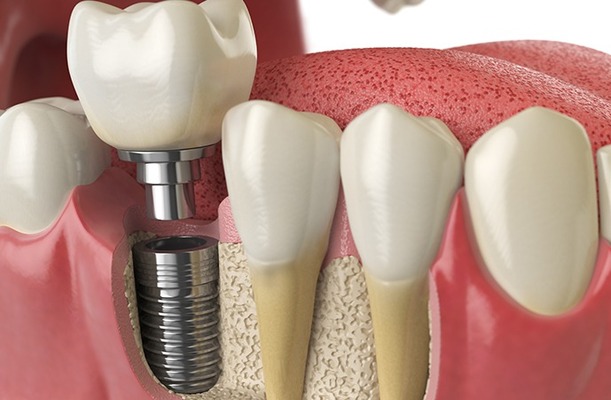Dental Implants vs. White Fillings in Melbourne CBD - Professional Community Article By Holistic Dental Melbourne CBD