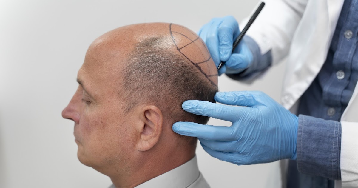 Everything You Need to Know About Hair Transplants: Benefits, Procedure, and Results
