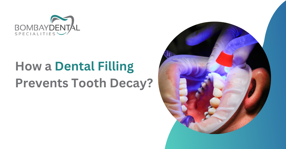 How a Dental Filling Prevents Tooth Decay? | Bombey Dental