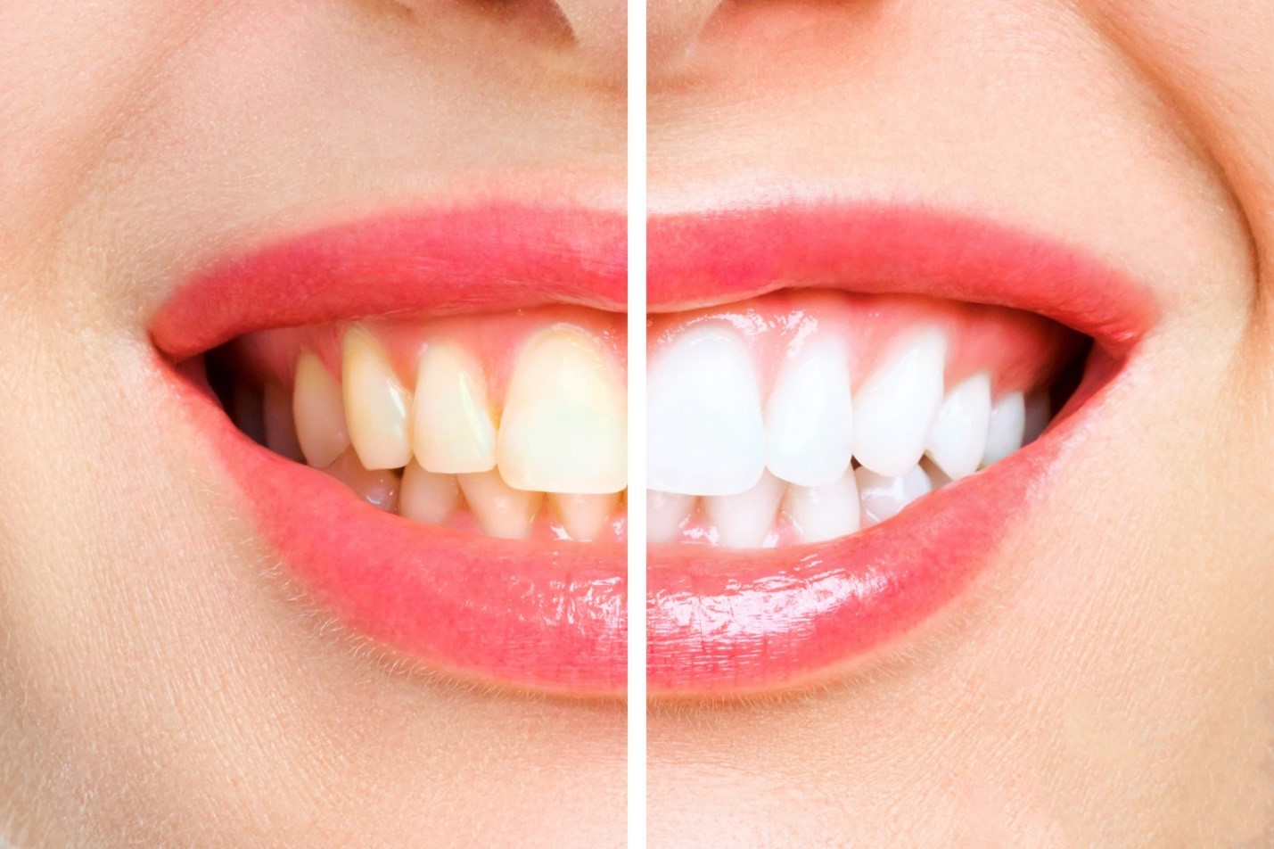 Teeth Whitening Questions To Ask From Your Dentist