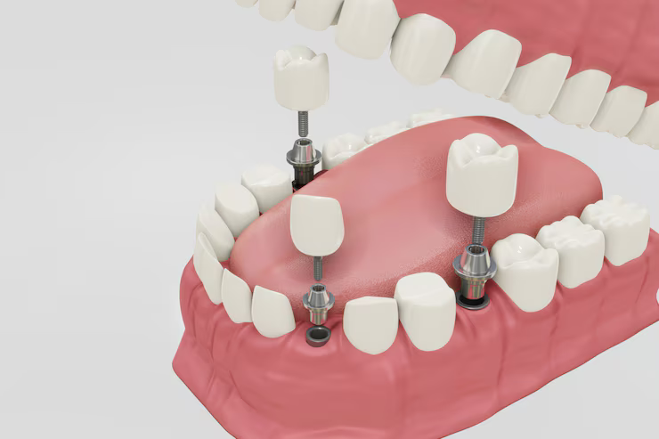 Dental Implants Cost - 4 Dental Grants to Help Pay For Dental Implants
