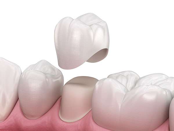 Dental Crowns & Bridges | Dental Implants Geelong | Get Dentist Caps
