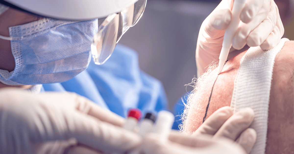 Haartransplantatie in Nederland: Beste resultaten