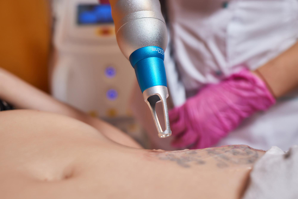 Guide To Laser Tattoo Removal In London | Bianco Beauty