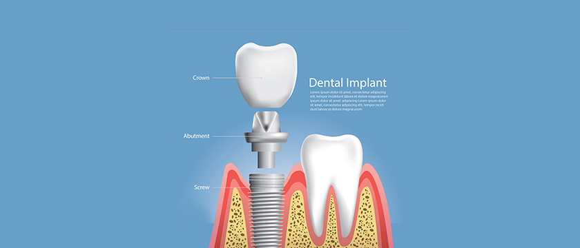 Achieve a Confident Smile: Dental Implants in South Delhi