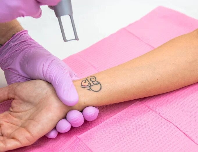 What To Expect At Your First Tattoo Removal Appointment? | by Bianco beauty | Jul, 2024 | Medium