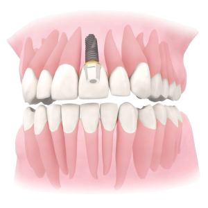 Dental Implants Sutton - Mulgrave Dental