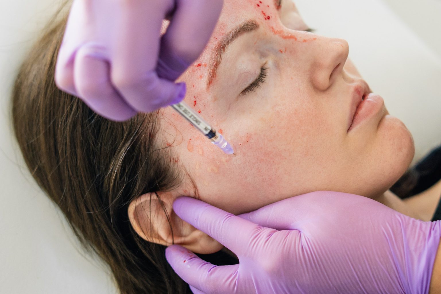 Vampire Facial for Anti-Aging: Everything You Need to Know | TechPlanet