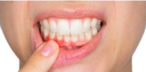 Periodontal Treatment | Expert Care for Gum Health