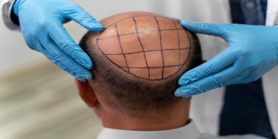 Hair Transplant in Riyadh & Saudi Arabia