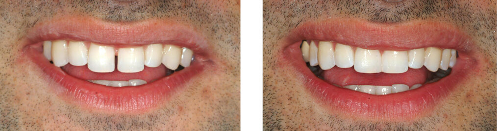 Bonding Veneers at Eternal Smiles Dental Centre