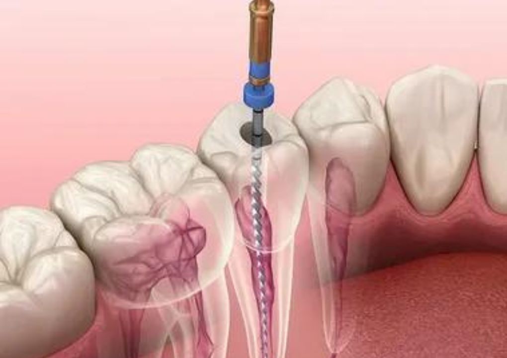 6 Benefits of Modern Root Canal Treatment - Click To Write