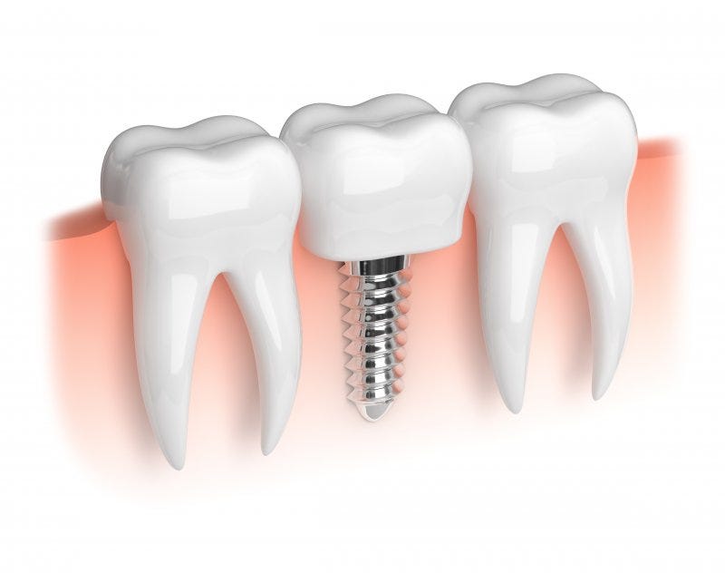 How Dental Implants Can Restore Your Bite? | by Dental Excellence | Aug, 2024 | Medium