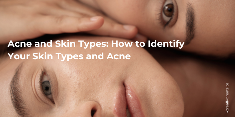 Acne and Skin Types: How to Identify Your Skin Types and Acne | Deoset