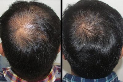 Hair Fall Treatment in Chennai | Cost of Hair Loss Treatment | Dr. Health Clinic