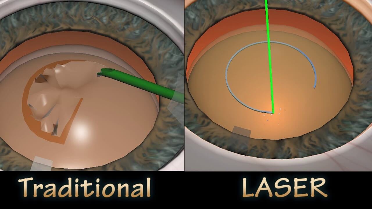 Traditional Cataract Surgery vs. Laser-Assisted Cataract Surgery