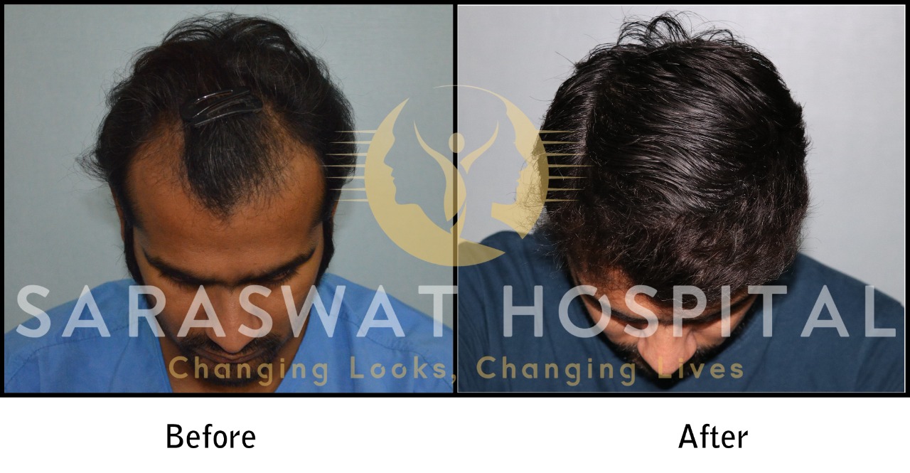 Hair Transplant Before & After Results | Saraswat Hospital