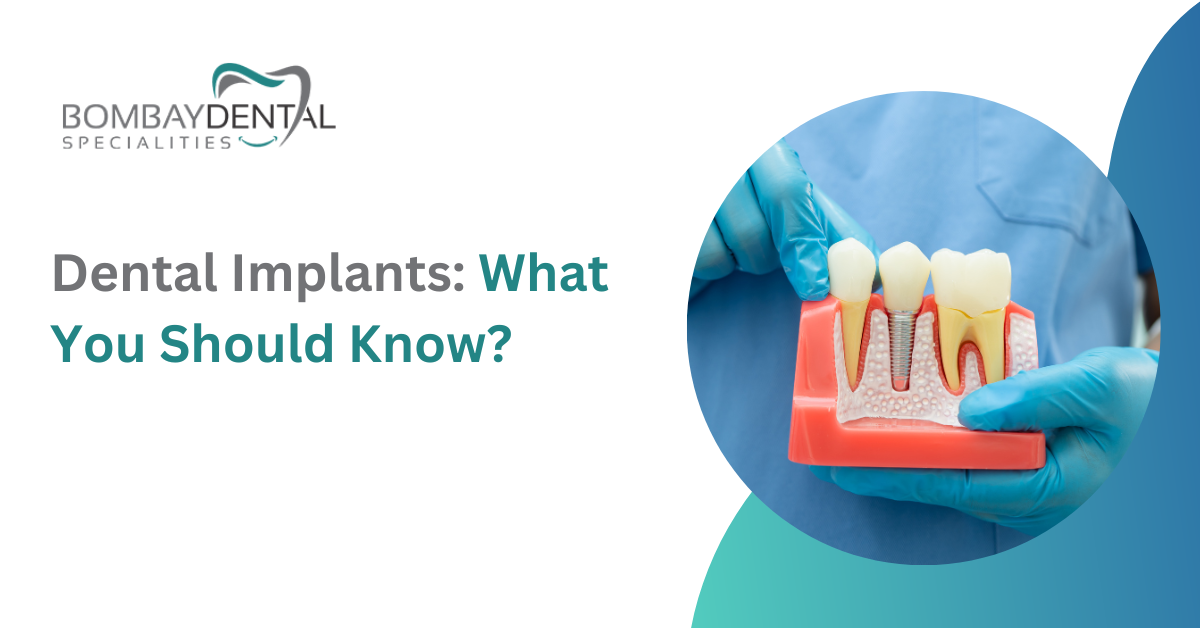 Dental Implants: What You Should Know? | Bombay Dental Specialities