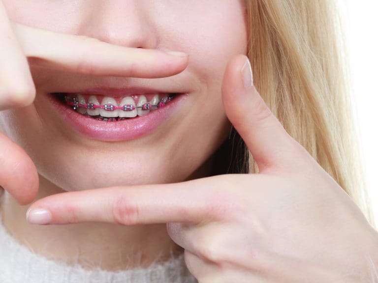 Orthodontic Appliances | PDG Dental | Pediatric Dentistry & Orthodontics