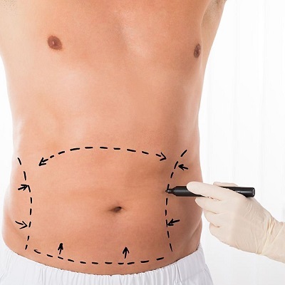 Tummy tuck in Islamabad Pakistan - ERCs