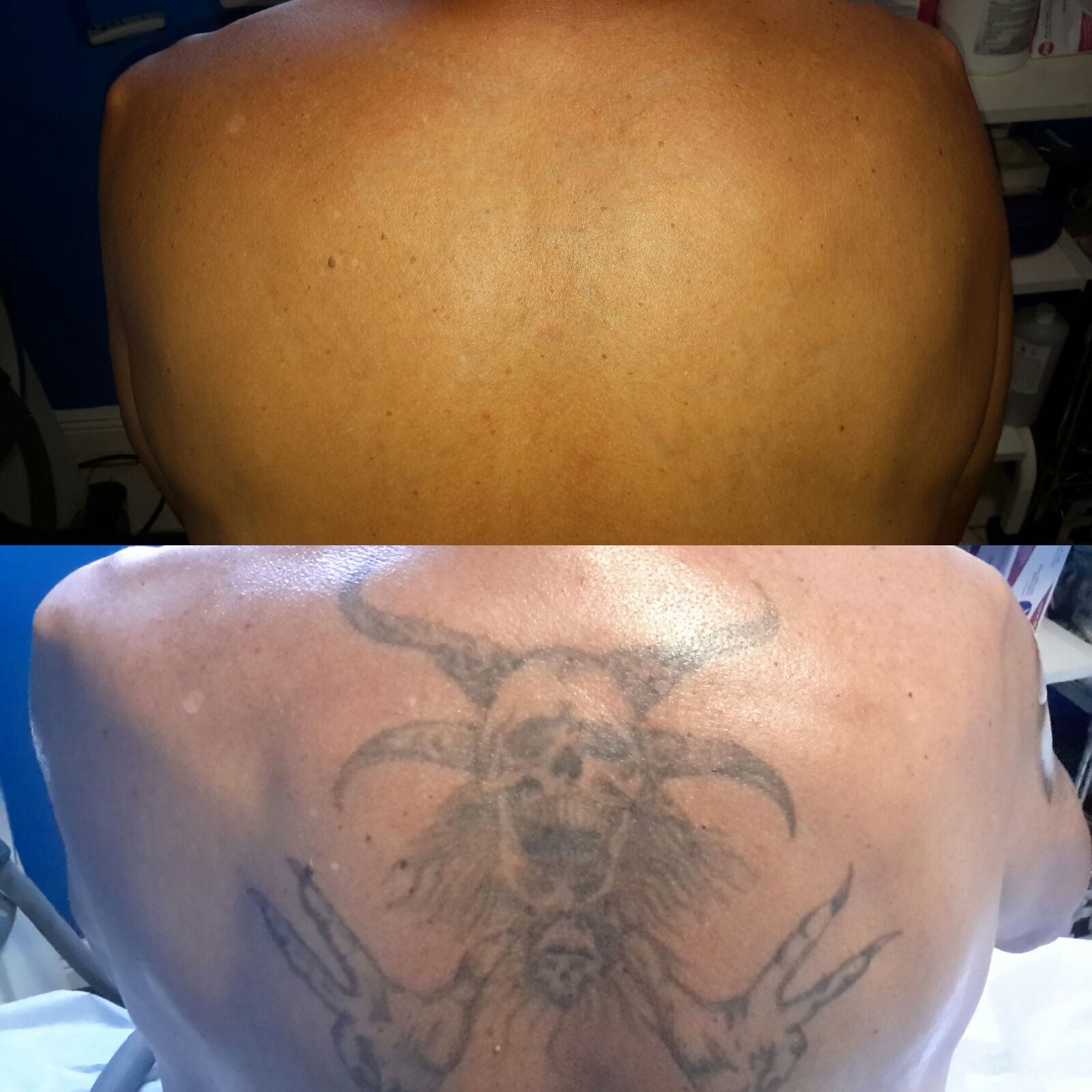 Winter Park Tattoo Removal Cover Image