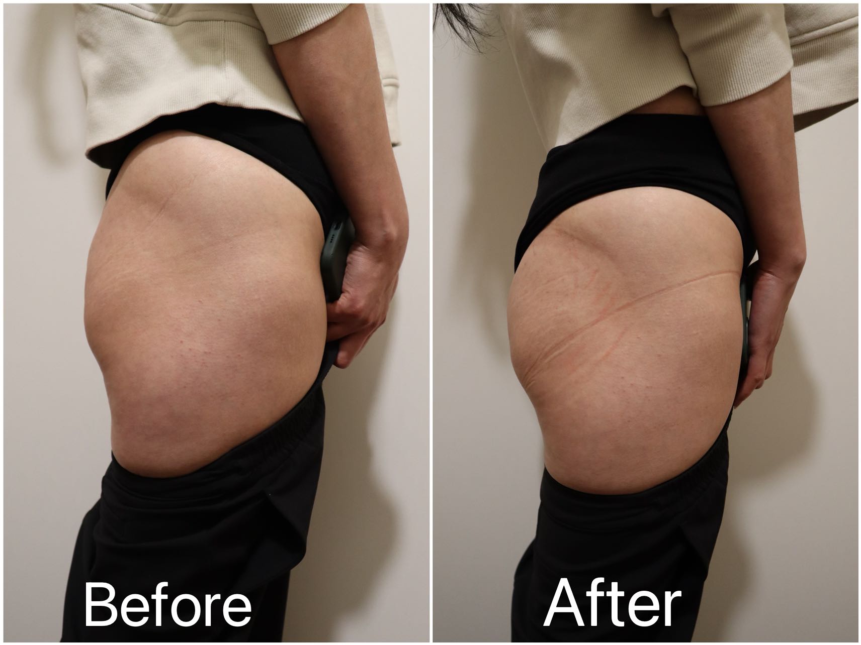 Enhance Your Curves with Our Butt Lifting Treatment in Surrey