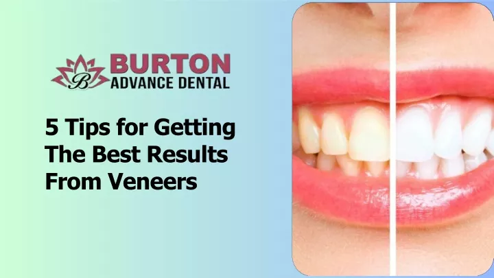 PPT - 5 Tips for Getting the Best Results from Veneers PowerPoint Presentation - ID:13656429