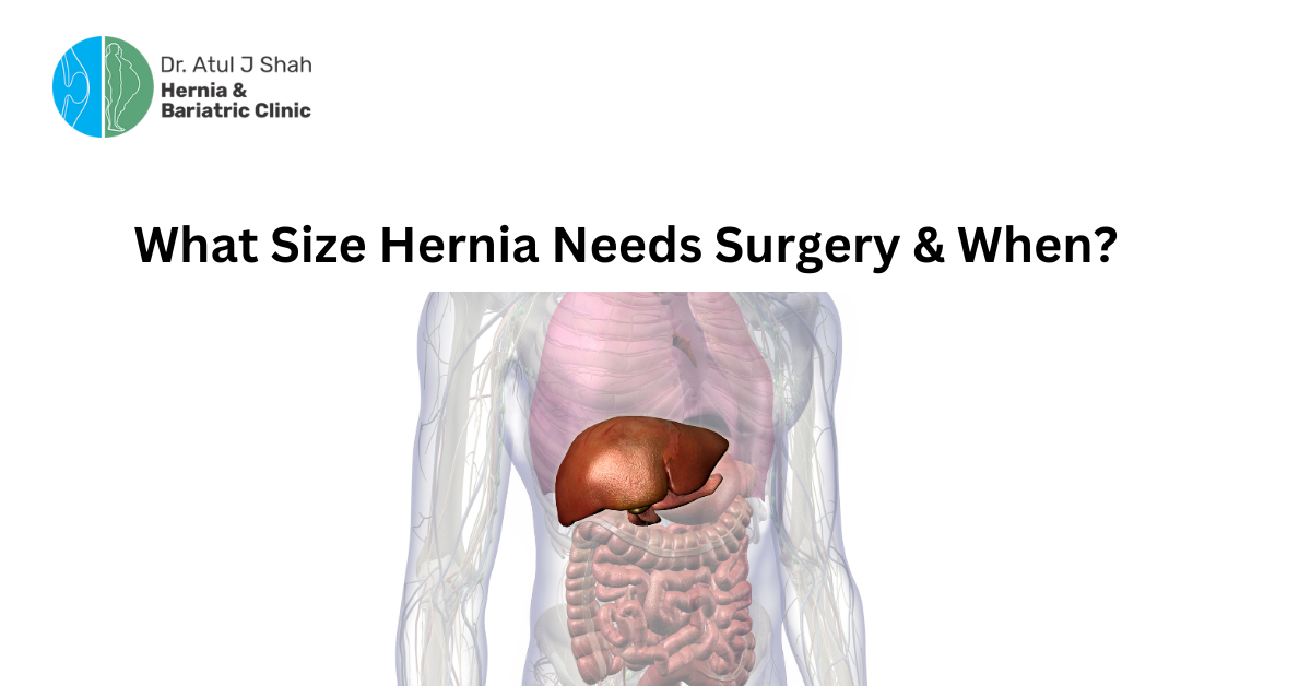 What Size Hernia Needs Surgery & When?| Dr. Atul Shah