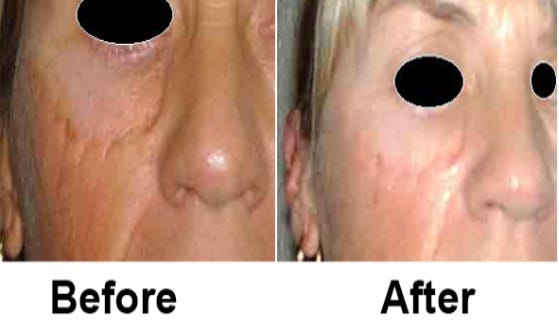 Skincare Regimens Before and After CO2 Laser Resurfacing in Dubai | by Skin Laser Dubai