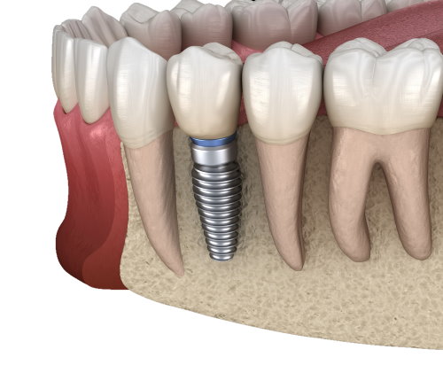 Are Dental Implants the Right Solution for You? Key Considerations – Telegraph