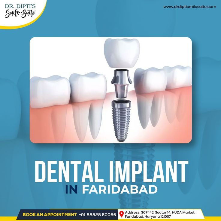 Top Clinics for Dental Implants in Faridabad in 2024