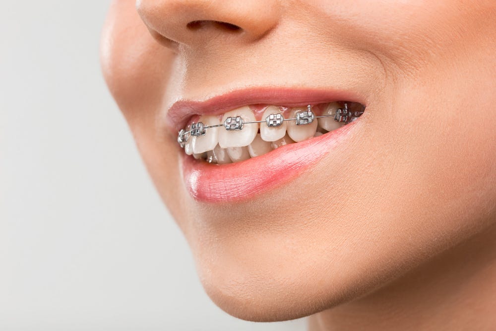 Benefits of Getting Dental Braces Near You: What to Expect | by Dr. Dipti Smile Suite | Oct, 2024 | Medium