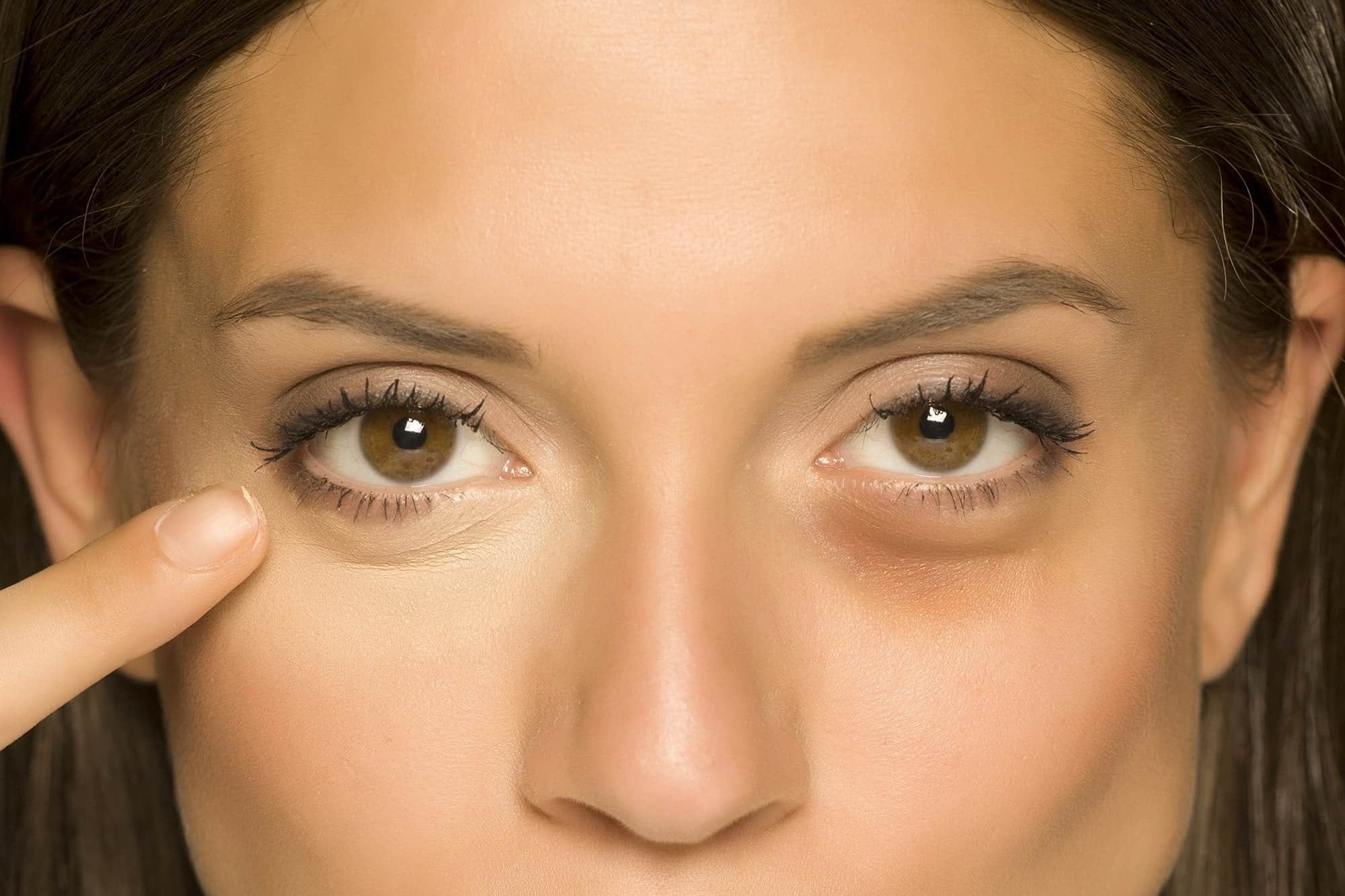 Ways to Get Rid of Eye Bags | Deevine Eye Care