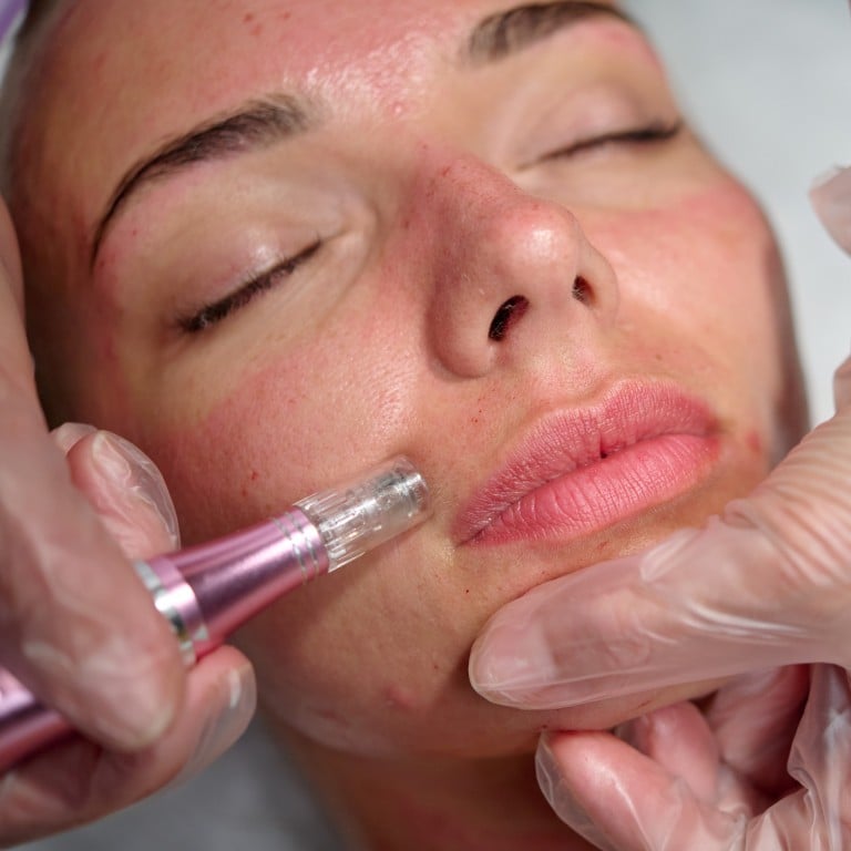 Whizolosophy | Microneedling in Newcastle: A Guide to Rejuvenated Skin