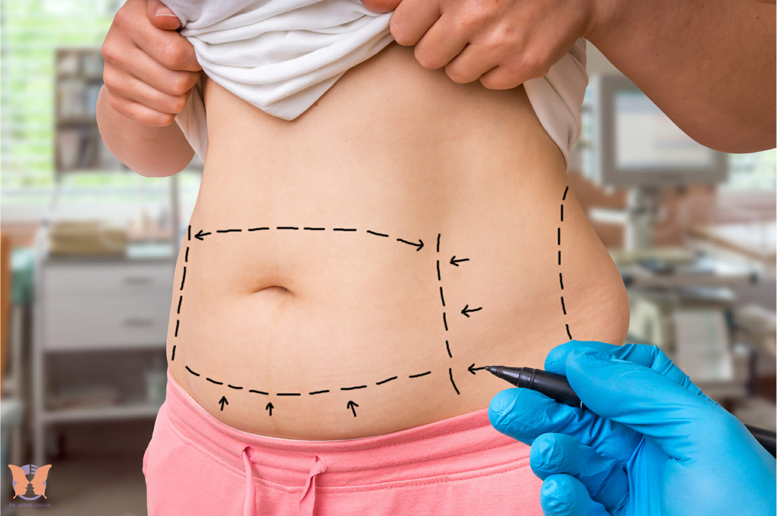 Tummy Tuck Recovery: Tips for a Smooth Healing Process