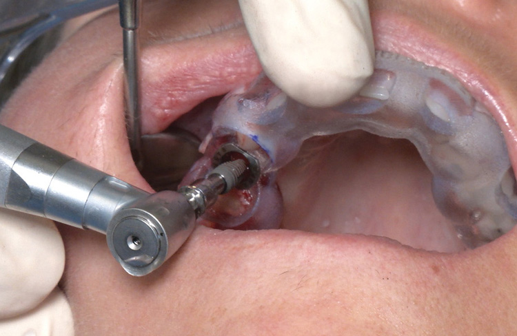 4 Advantages of Dental Implant Guides For Your Dental Practice