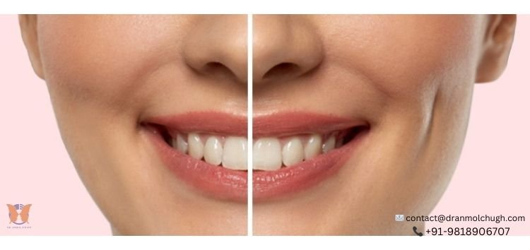 Dimple Creation Surgery: How to Get the Smile of Your Dreams?