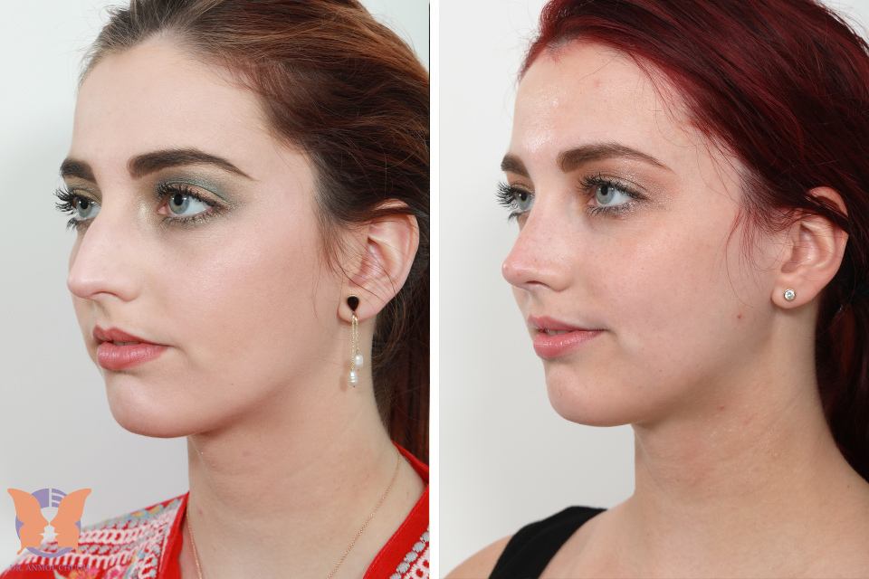 Celebrity Rhinoplasty Surgery: Secrets to the Perfect Nose