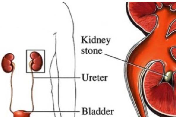 Finding the Right Kidney Stones Specialist: Everything You Need to Know - Free Article Submission Sites List instant Approval - Post Your Article