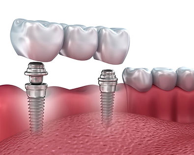 Types of Dental Implants | Implant Center