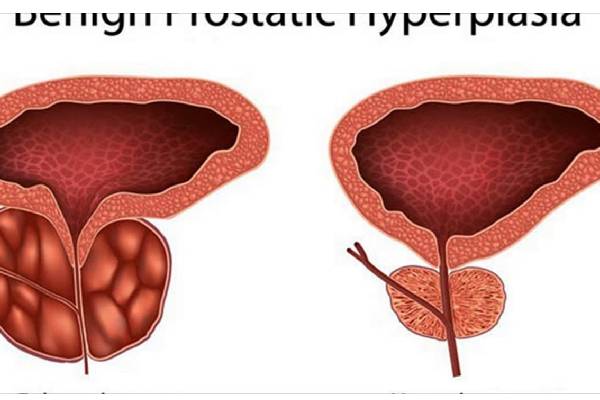 Prostate Doctor: Importance, Specializations, and When to See One - Global Post News, Guest Posting Sites, Article Submission