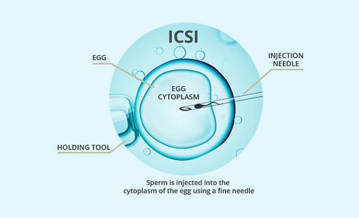 ICSI Treatment Cost in Delhi | Dr. Rhythm Gupta