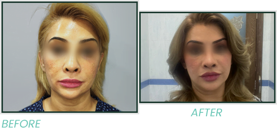 Facelift in Lahore: Cosmetic Facelift Surgery in Pakistan