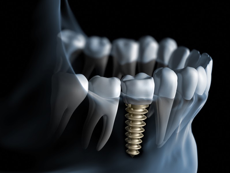 How does implant dentistry in Carleton Place restore smiles for life?