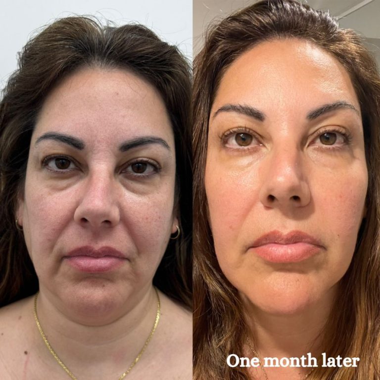High Intensity Focused Ultrasound (HIFU) Treatment