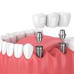 Dental Implants in Riyadh profile picture