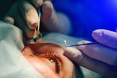 Cataract Surgery Cost in Bangalore – Affordable Eye Surgery Packages